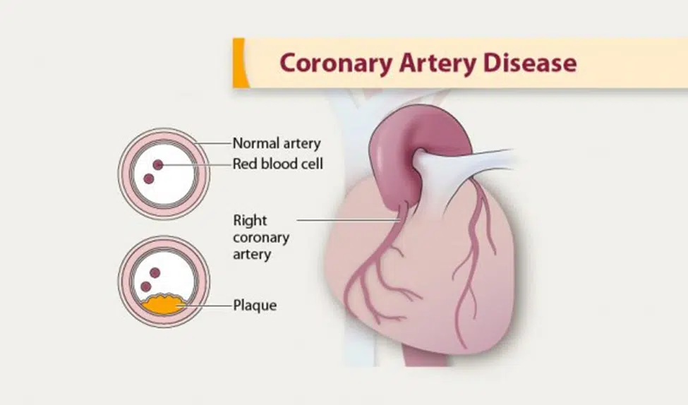 coronary artery disease illustration